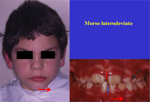 Fig.5 laterodeviazione