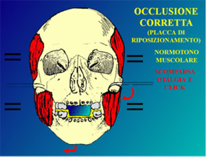 Fig.6 terapia occlusale